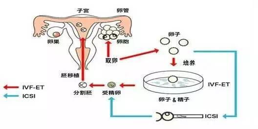 临沂试管婴儿
